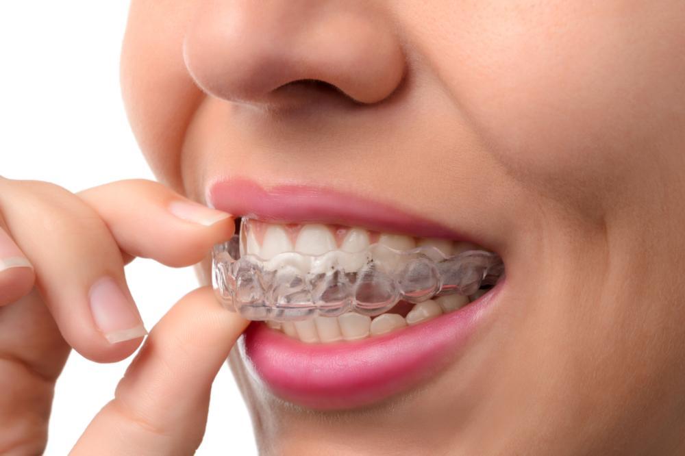 Invisalign pascoe vale vic