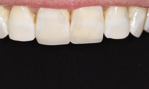 worn down front teeth after | cosmetic dentist pascoe vale