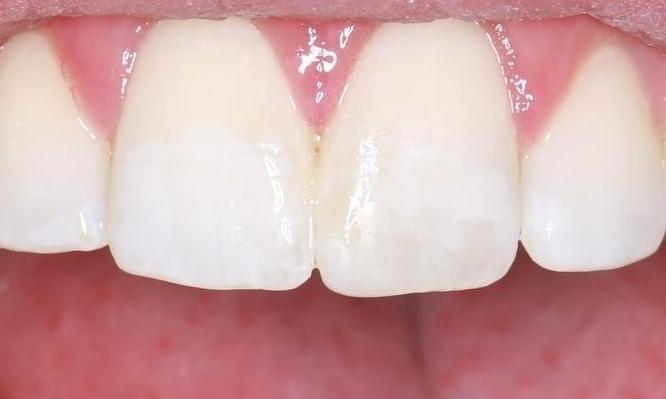 chipped front tooth after | cosmetic dentist pascoe vale