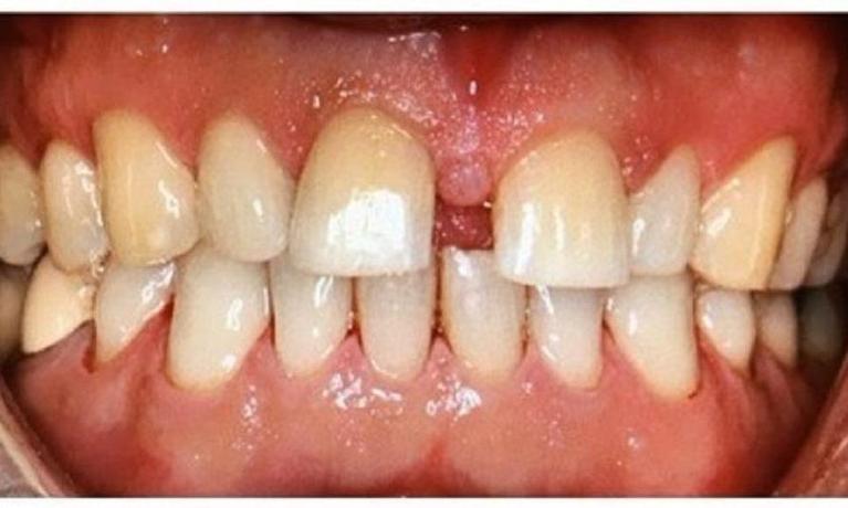 after comprehensive dental cleaning | pascoe vale dentist