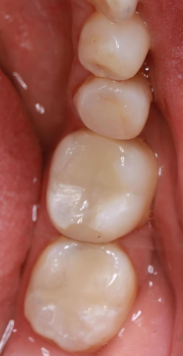 tooth-coloured fillings | pascoe vale vic