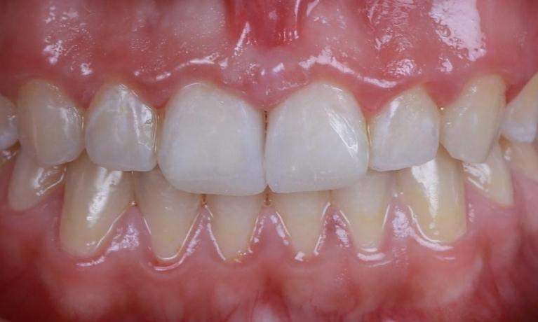 white spots on teeth fixed | dentist pascoe vale
