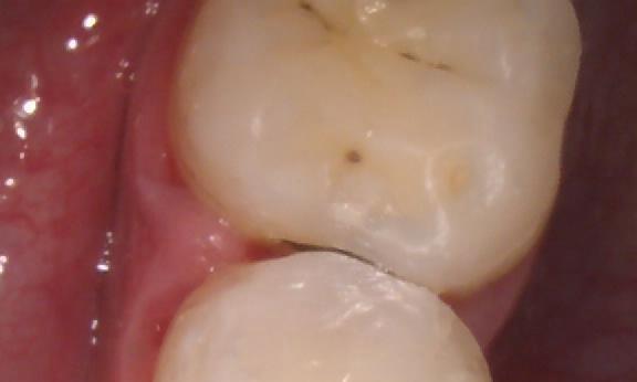 tooth coloured fillings | pascoe vale vic