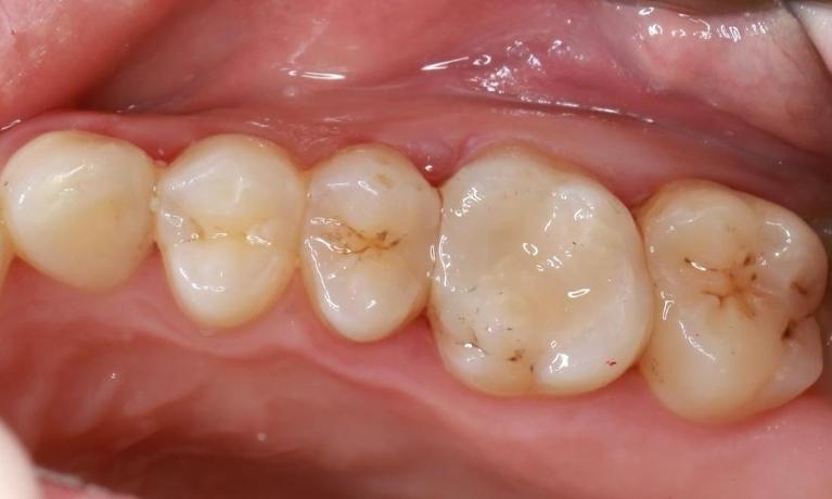 silver filling replaced with white filling | pascoe vale vic