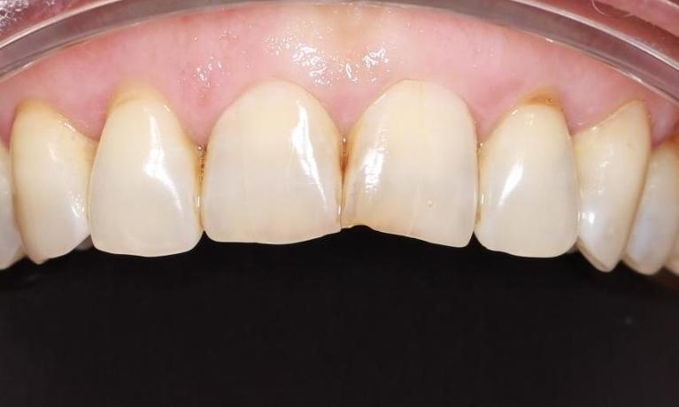 worn down front teeth before | cosmetic dentist pascoe vale