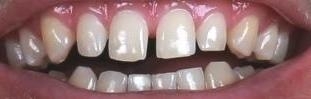 smile design before picture | pascoe vale dentist