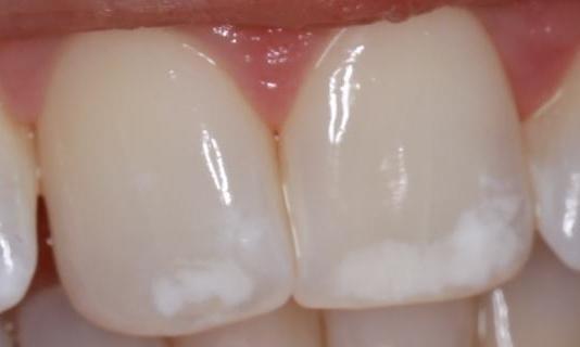 white spots on front teeth | cosmetic dentist pascoe vale