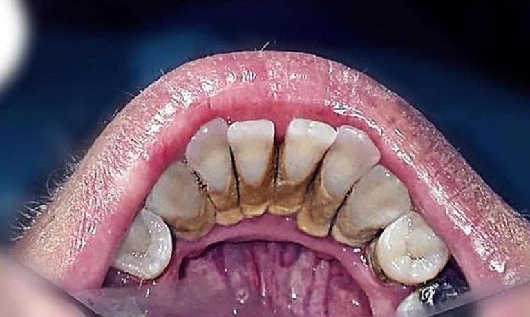 a patients mouth before removing plaque | dentist pascoe vale