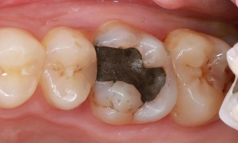 tooth with silver filling | dentist pascoe vale vic
