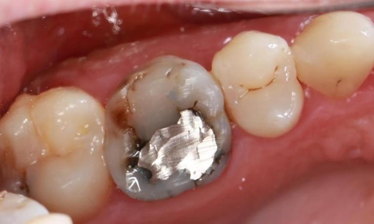 old silver filling | dentist pascoe vale vic
