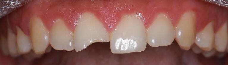 Smile design