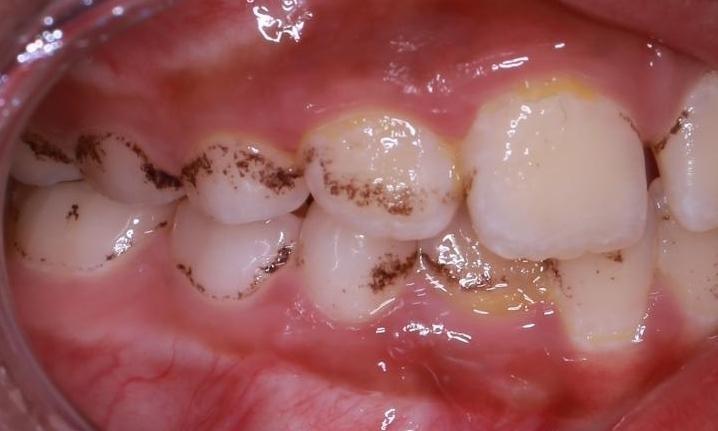 side view before dental cleaning | pascoe vale dentist