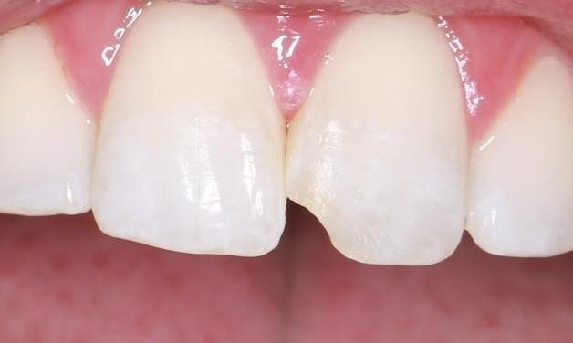 chipped front tooth before | cosmetic dentist pascoe vale