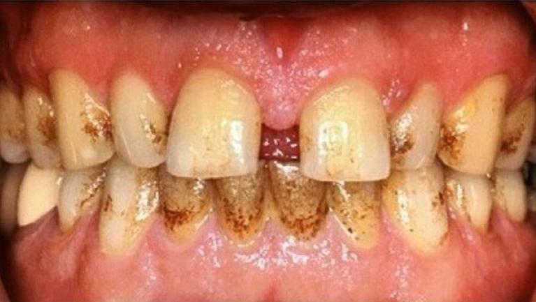 before comprehensive dental cleaning | pascoe vale dentist