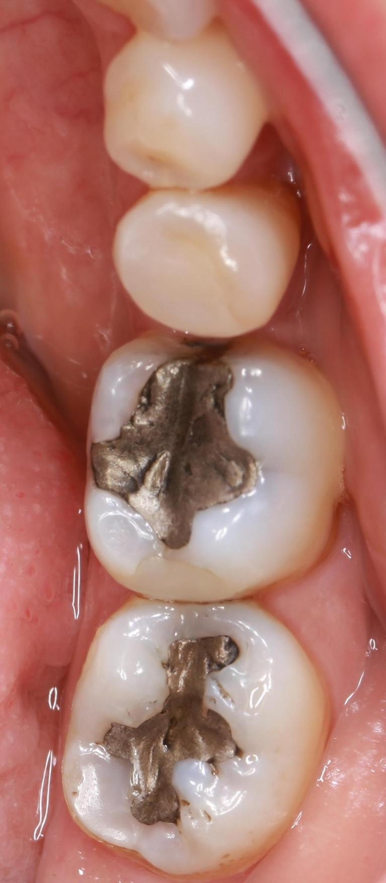 large silver fillings | dentist pascoe vale vic