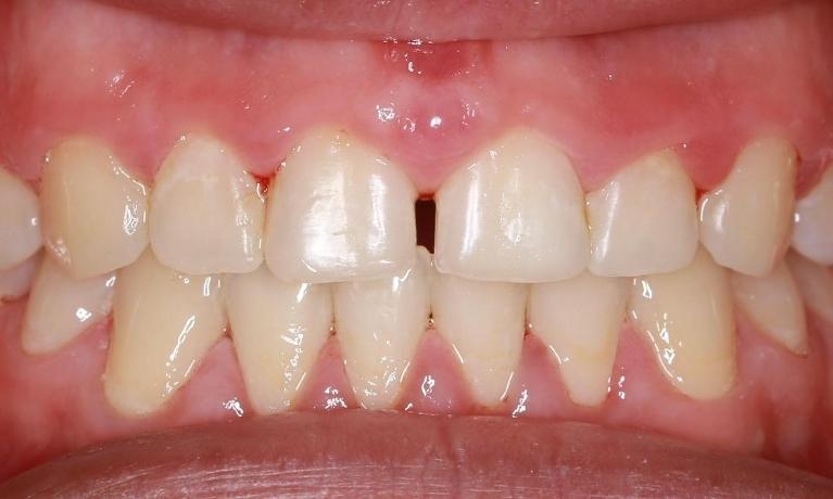 white spots on teeth fixed | dentist pascoe vale