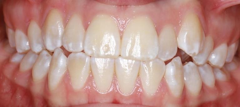 straight teeth | pascoe vale vic