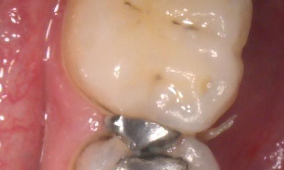 silver fillings | pascoe vale vic