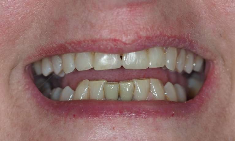 Close up of womans mouth after broken tooth fixture, pascoe vale