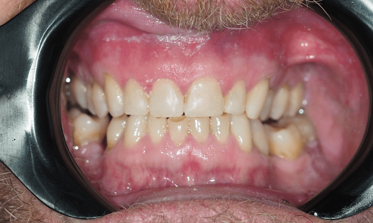 Close up of mouth after composite bonding, pascoe vale vic
