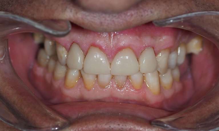 Close up of mouth after composite bonding, pascoe vale vic