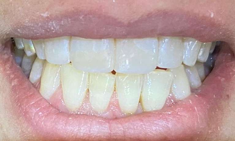 View of mouth after composite fillings, pascoe vale vic