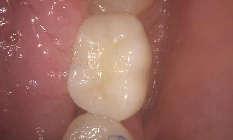 Implant crown after, pascoe vale vic