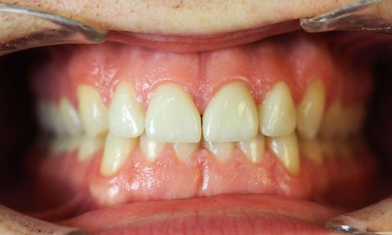 Mouth after invisalign and build-up of front teeth, pascoe vale vic