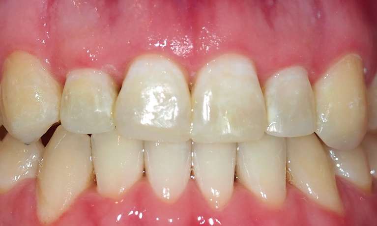 After orthodontic treatment to remove composite buildup of on front teeth, pascoe vale vic