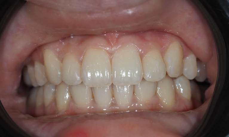 View of mouth after overbite corrected using invisalign, pascoe vale vic