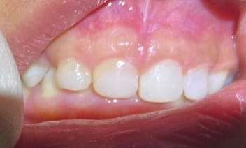View of mouth after paediatric composite fillings, pascoe vale vic