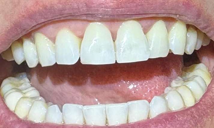 Full mouth after teeth whitening, pascoe vale vic