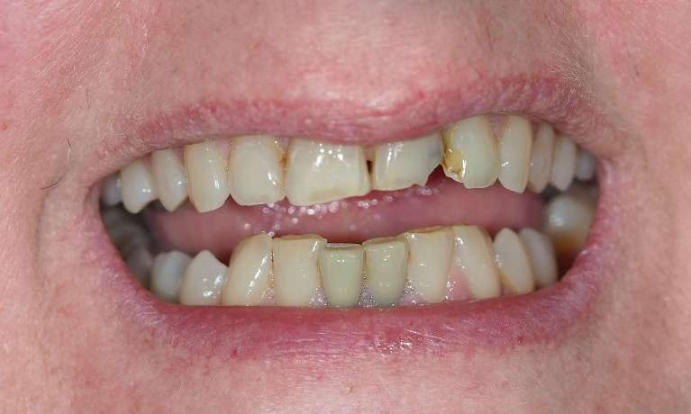 Close up of womans mouth before broken tooth fixture, pascoe vale