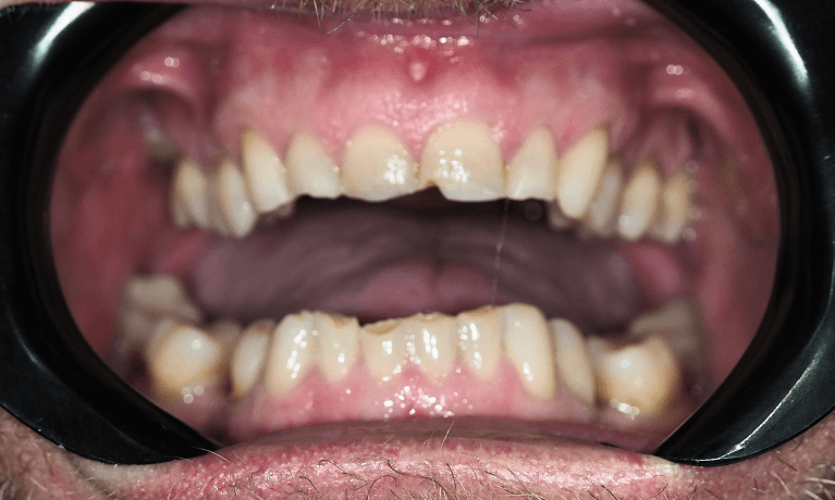 Close up of mouth before composite bonding, pascoe vale vic