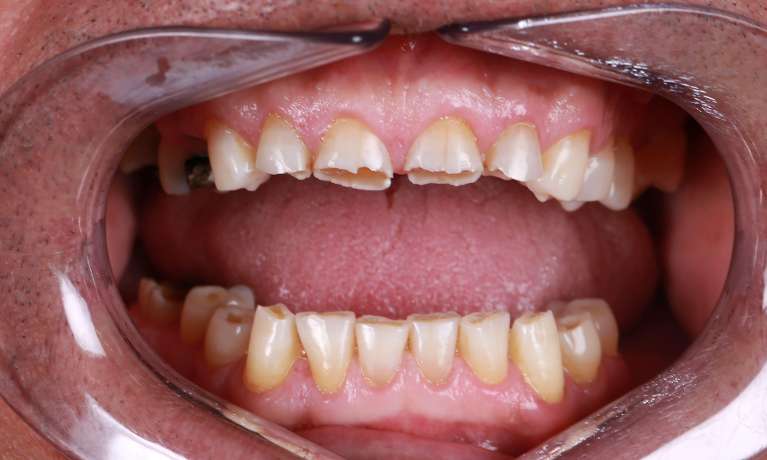 Close up of mouth before composite bonding, pascoe vale vic