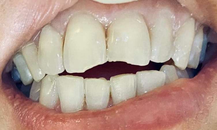 View of mouth before composite fillings, pascoe vale vic