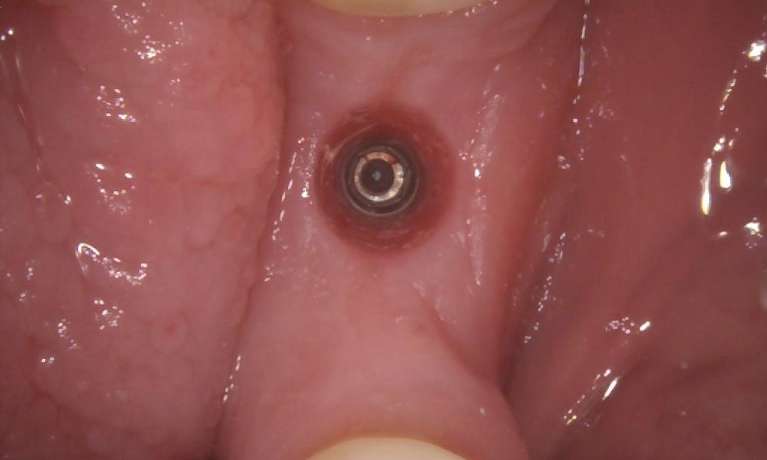 Implant crown before, pascoe vale vic