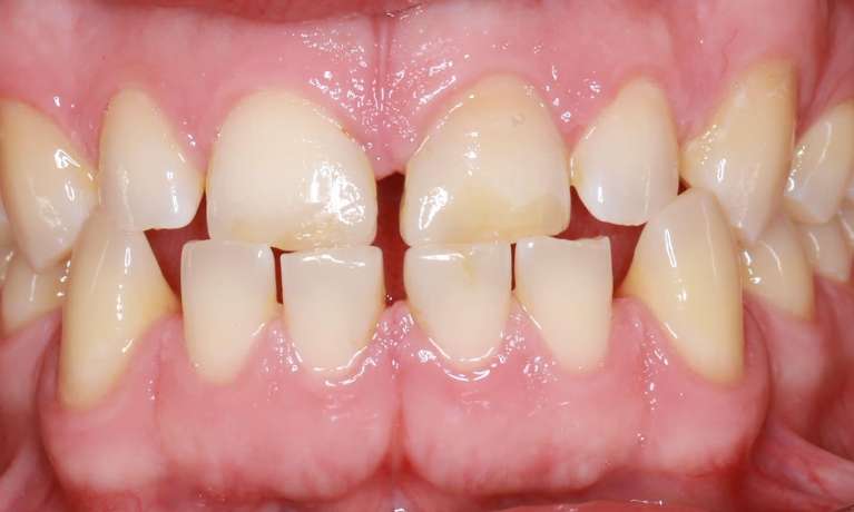 Mouth before invisalign and build-up of front teeth, pascoe vale vic
