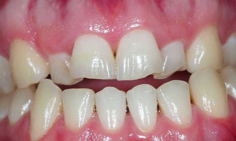 Before orthodontic treatment to remove composite buildup of on front teeth, pascoe vale vic