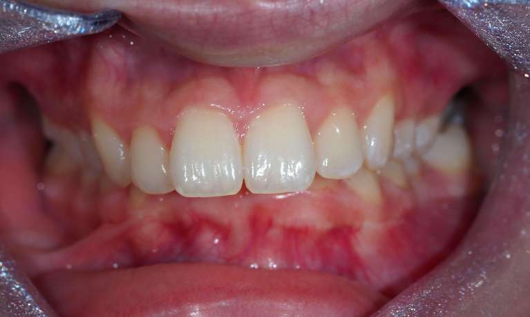 View of mouth before overbite corrected using invisalign, pascoe vale vic