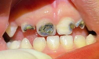 View of mouth before paediatric composite fillings, pascoe vale vic