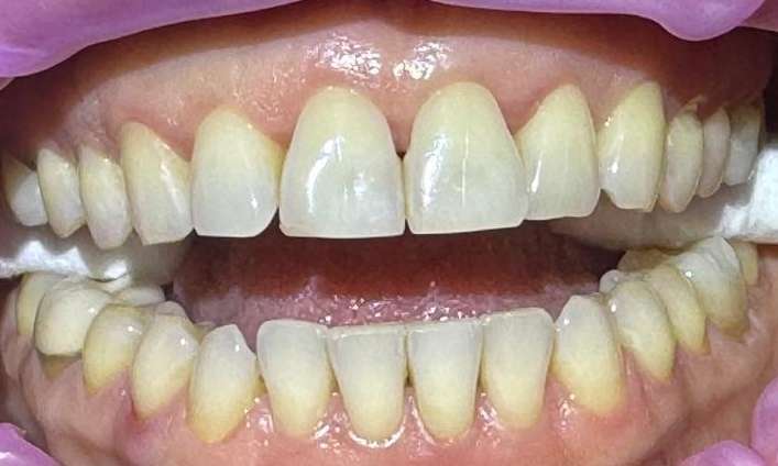Full mouth before teeth whitening, pascoe vale vic